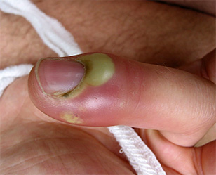 Панариций пальца лечение на ноге хирургическое лечение