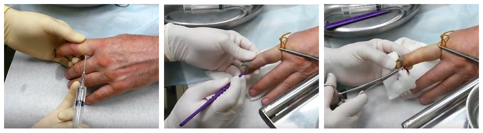 Панариций пальца лечение на ноге хирургическое лечение