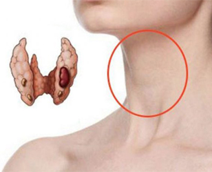 Лечение кисты щитовидной железы цена