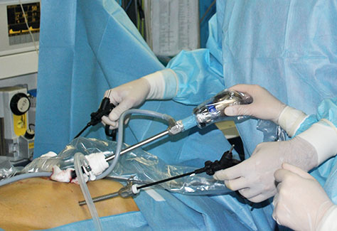 Лапароскопическая хирургия паховых грыж
