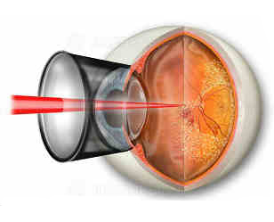 Разрыв сетчатки глаза сколько стоит операция
