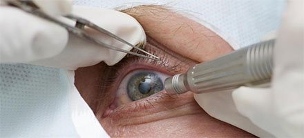 Клиника хирургии глаза лечение