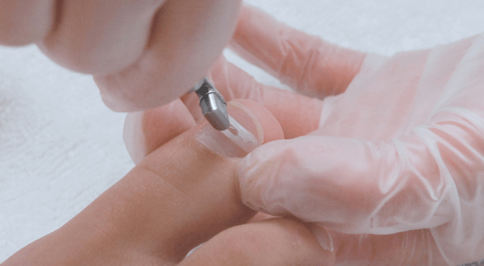 Удаление вросшего ногтя