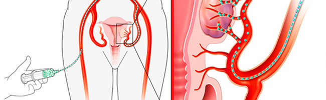 Эмболизация маточных артерий: остановить рост миомы без её удаления
