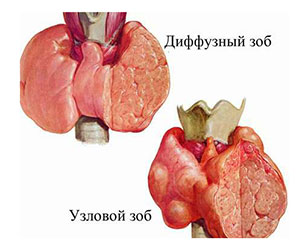 Зоб щитовидной железы хирургическое лечение
