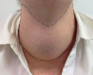 Хирургическое лечение узлового зоба щитовидной железы