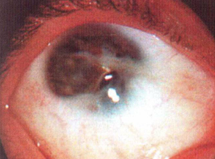 Субатрофия глазного яблока при отслойке сетчатки